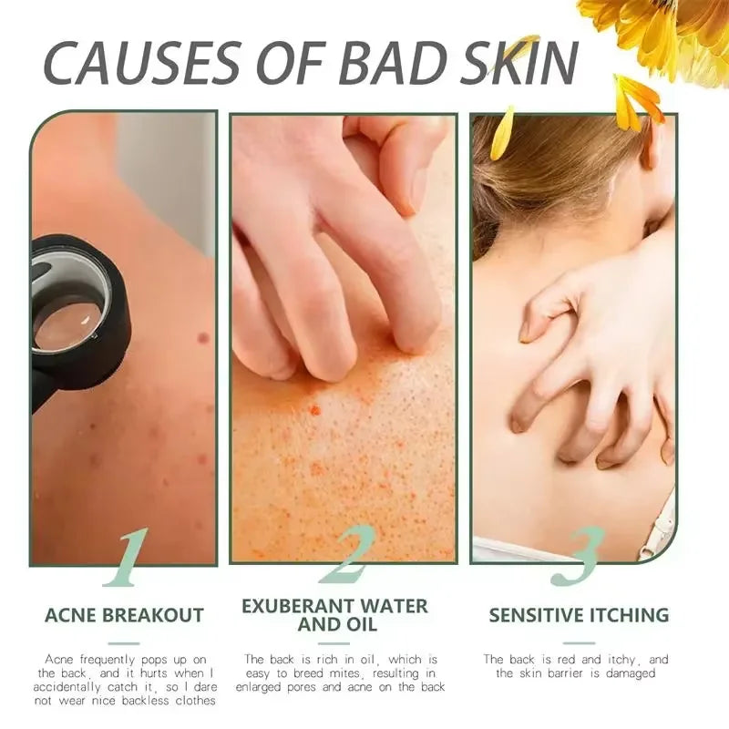 Salicylic Acid Acne Treatment Cream for Pore Care
