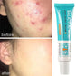 Salicylic Acid Acne Treatment Cream for Pore Care