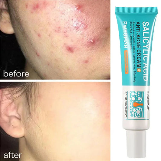 Salicylic Acid Acne Treatment Cream for Pore Care