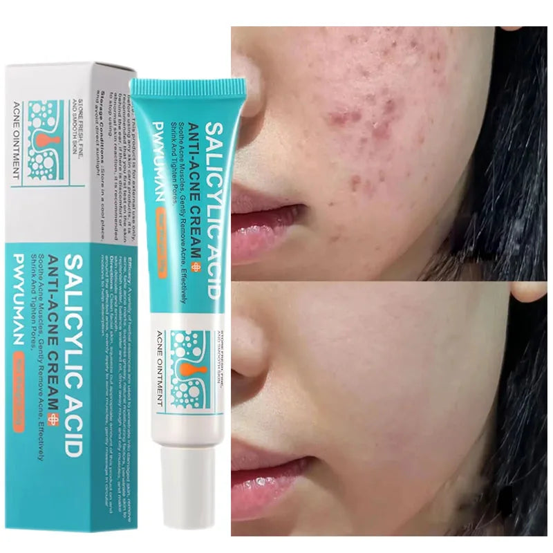 Salicylic Acid Acne Treatment Cream for Pore Care