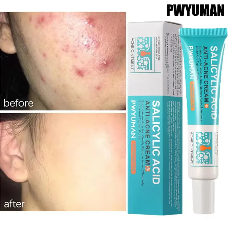Salicylic Acid Acne Treatment Cream for Pore Care