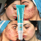 Salicylic Acid Acne Treatment Cream for Pore Care