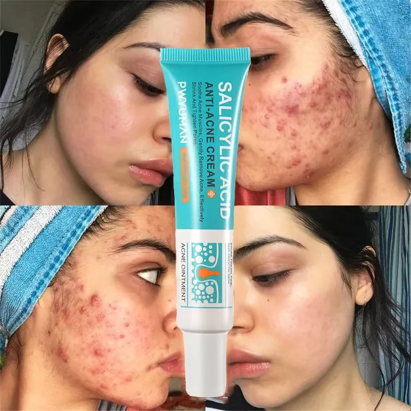 Salicylic Acid Acne Treatment Cream for Pore Care