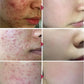 Salicylic Acid Acne Treatment Cream for Pore Care