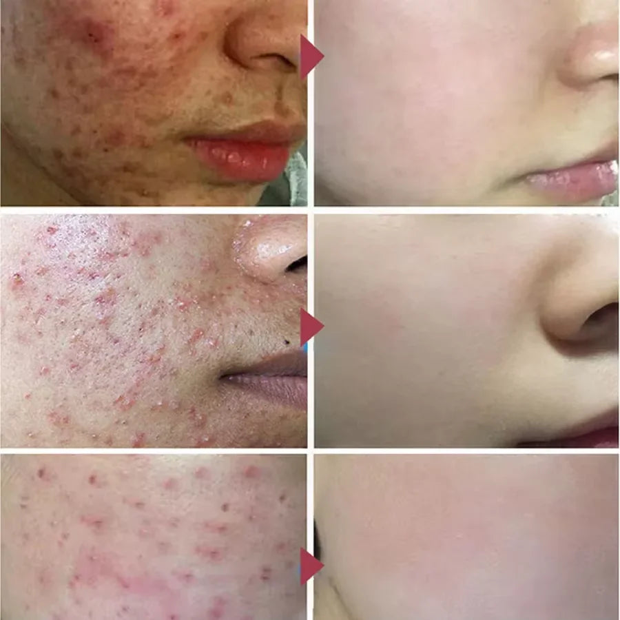 Salicylic Acid Acne Treatment Cream for Pore Care