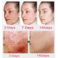 Salicylic Acid Acne Treatment Cream for Pore Care