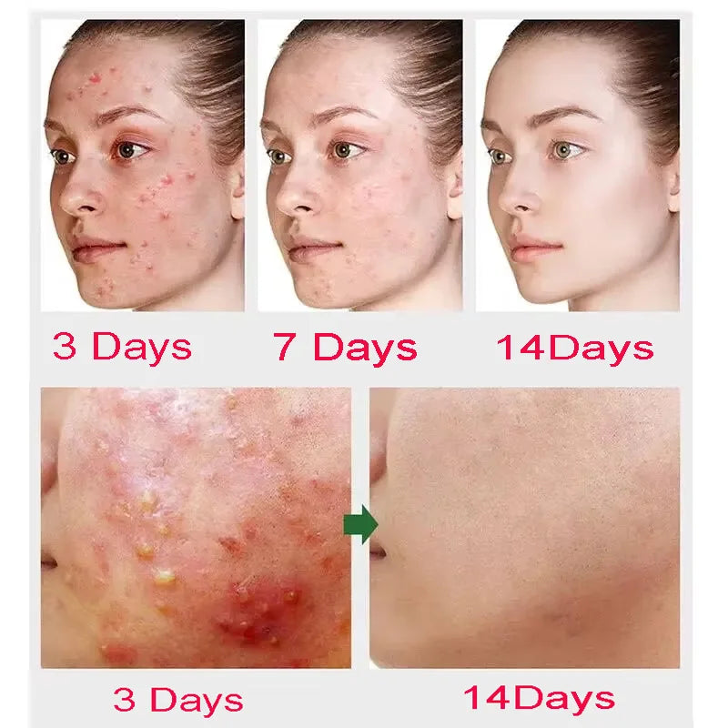 Salicylic Acid Acne Treatment Cream for Pore Care